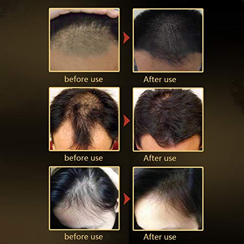 Ofanyıa Saç Çıkma Serumu Besler Saç Kökü Anti-Saç Dökülmesi Saç Büyüme Serumu Kadınlar ve Erkekler için